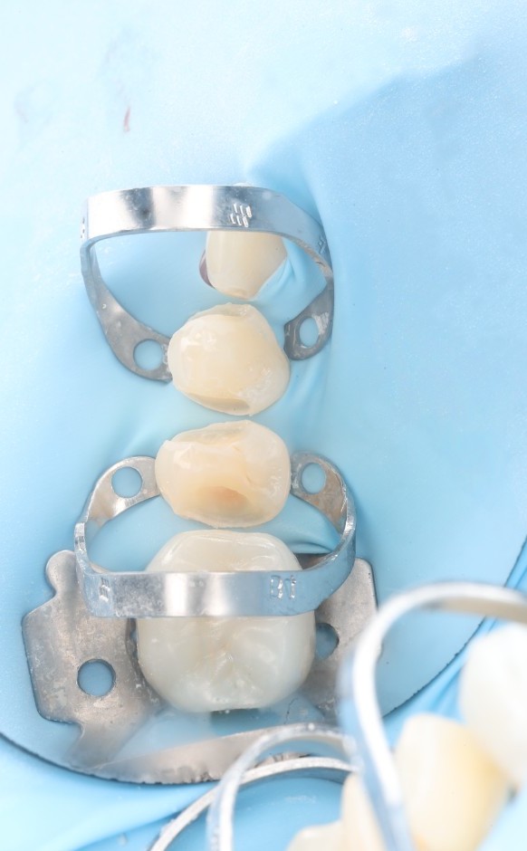 Mid-procedure view of two restored teeth with a metal matrix band still wrapped around one of them.