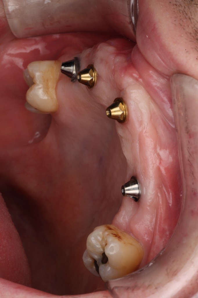 Healed implant abutments in the gum, lateral view.