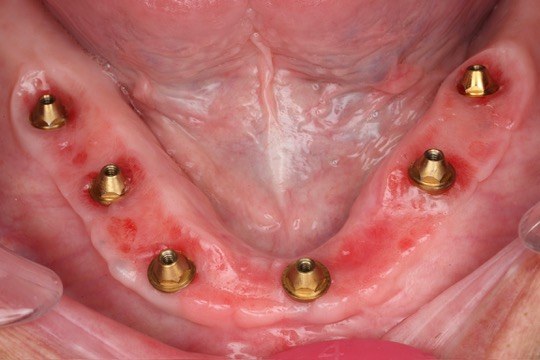 Top-down view showing healed implant abutments.