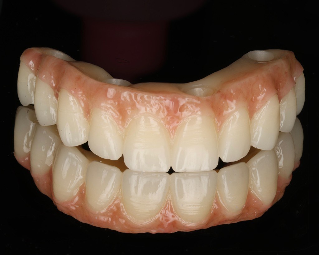 Full implant prosthesis on a black background, screw access holes visible.