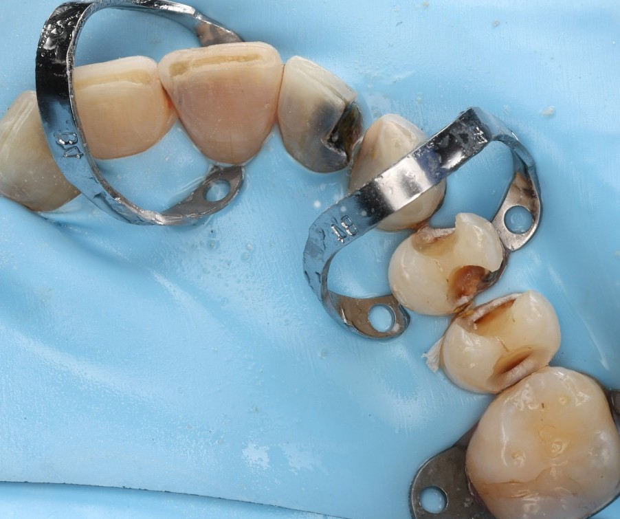 Multiple teeth being rebuilt under rubber dam isolation.