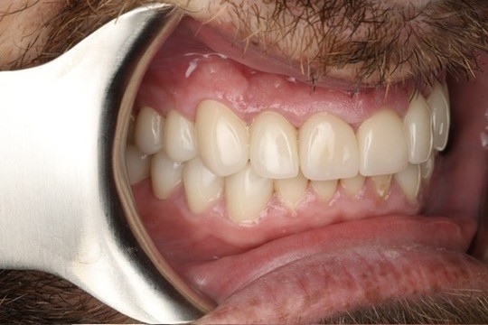 The patient today — another post-op view of the restored teeth and crowns.