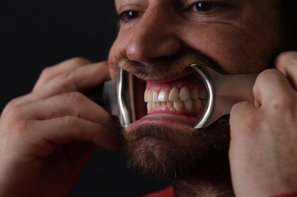 Pre-op view with cheek retractor — severe decay across multiple teeth.